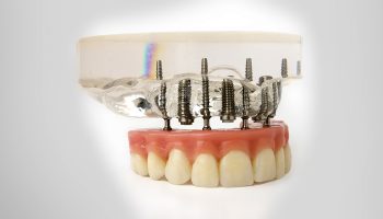 I’ve Lost a Tooth! Do I need a dental implant?