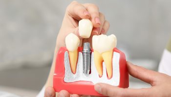 Different Types of Dental Implants