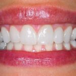 Can Cosmetic Dentistry Repair Receding Gums?