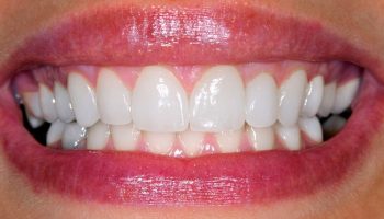 Can Cosmetic Dentistry Repair Receding Gums?