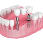 dental implant in Bolton