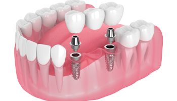 Can You Get Dental Implants If You Already Have Dentures?