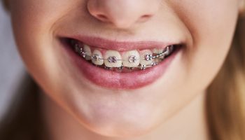 How Orthodontics Can Help with TMJ Disorders?