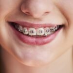 How Orthodontics Can Help with TMJ Disorders?