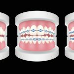 lightForce braces vs traditional braces