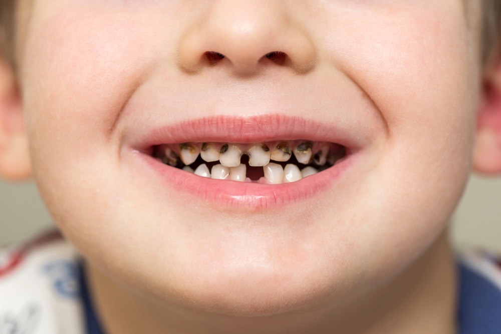 how can i prevent Cavities in my child, and how often should i take my child for a dental visit