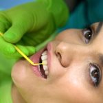 what are dental sealants and who needs them
