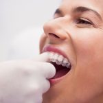 Why Invisalign Is Popular for Smile Correction