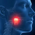 Illustration Showing Impacted Wisdom Tooth Causing Jaw Pain And Dental Discomfort