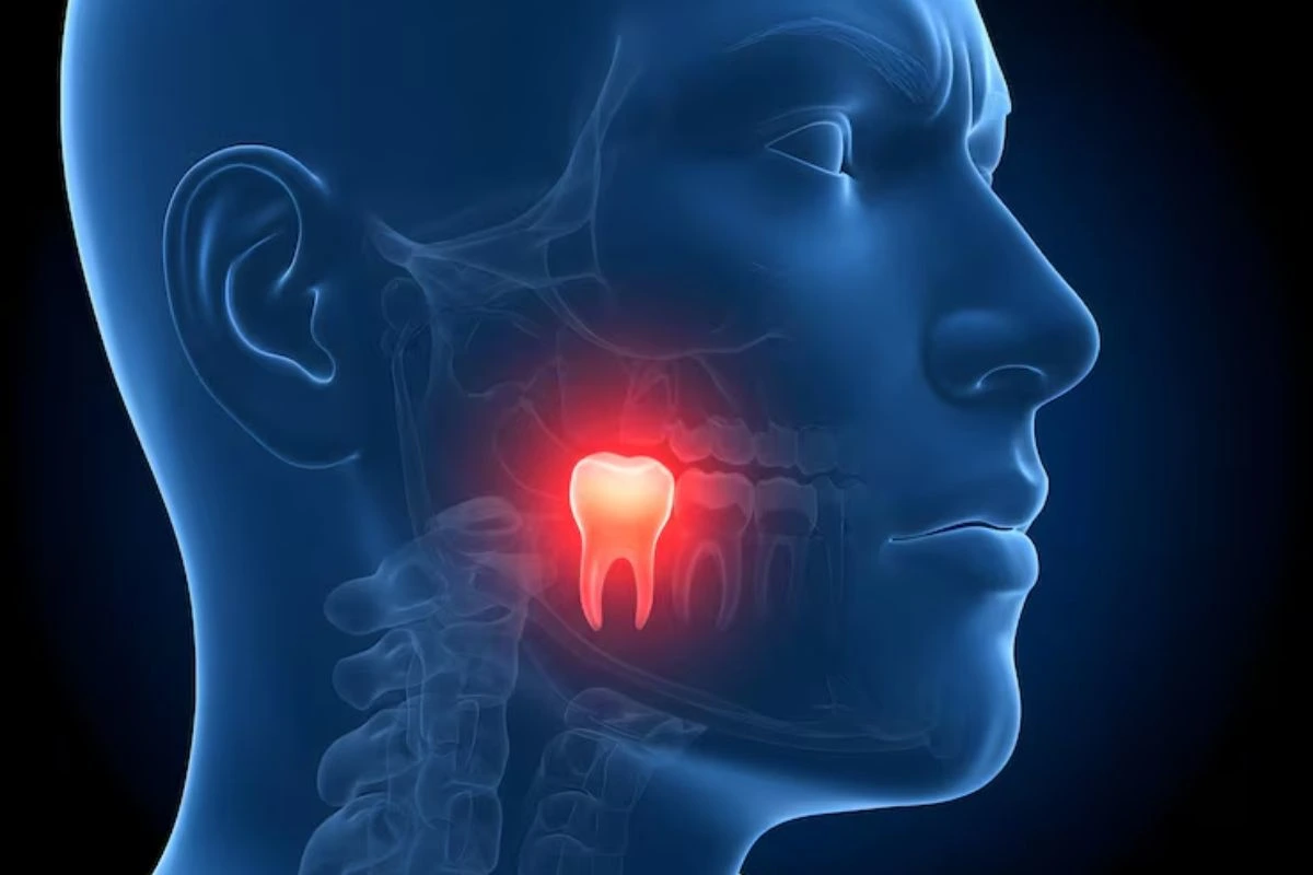 Illustration Showing Impacted Wisdom Tooth Causing Jaw Pain And Dental Discomfort