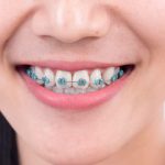 Woman Smiling With Clear Lightforce Braces For Orthodontic Teeth Straightening Treatment