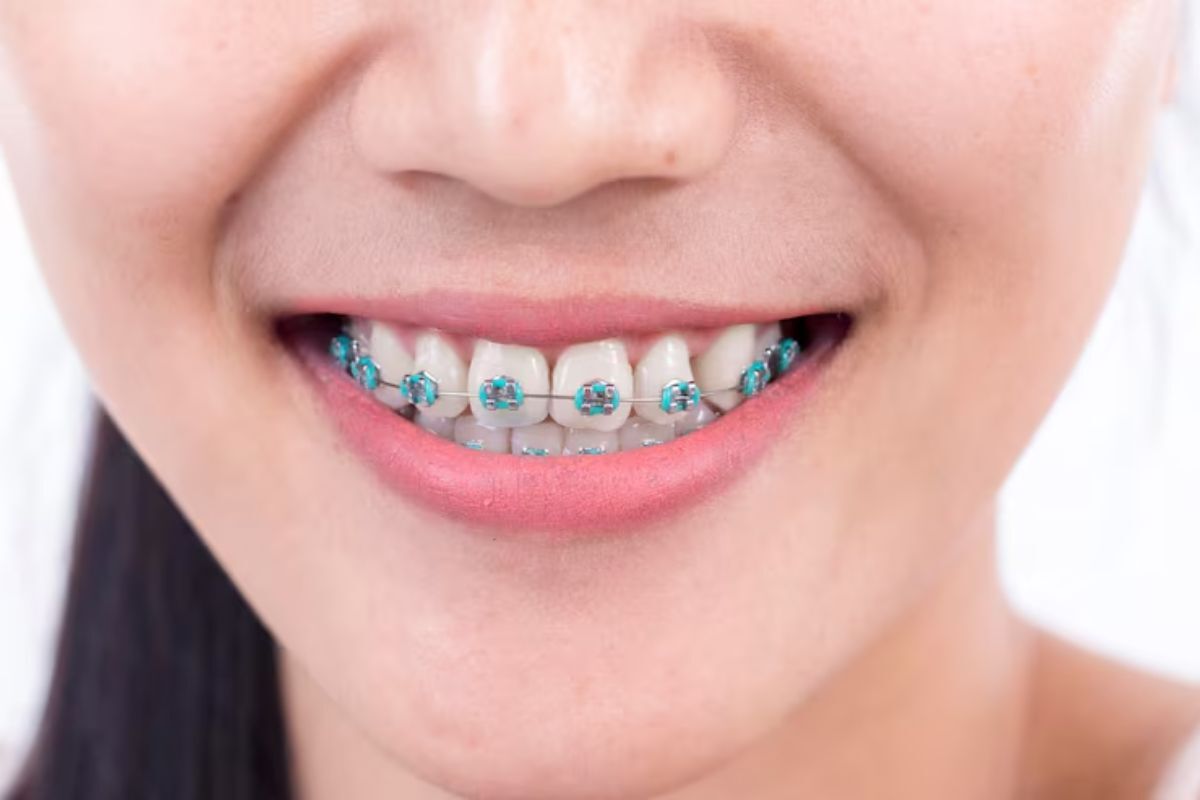 Woman Smiling With Clear Lightforce Braces For Orthodontic Teeth Straightening Treatment