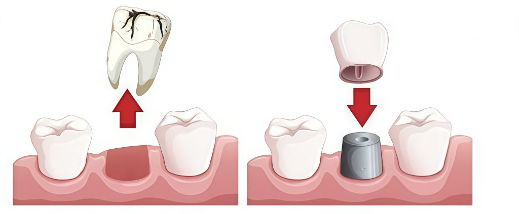 Tooth extraction vs Root canal