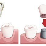 Tooth extraction vs Root canal