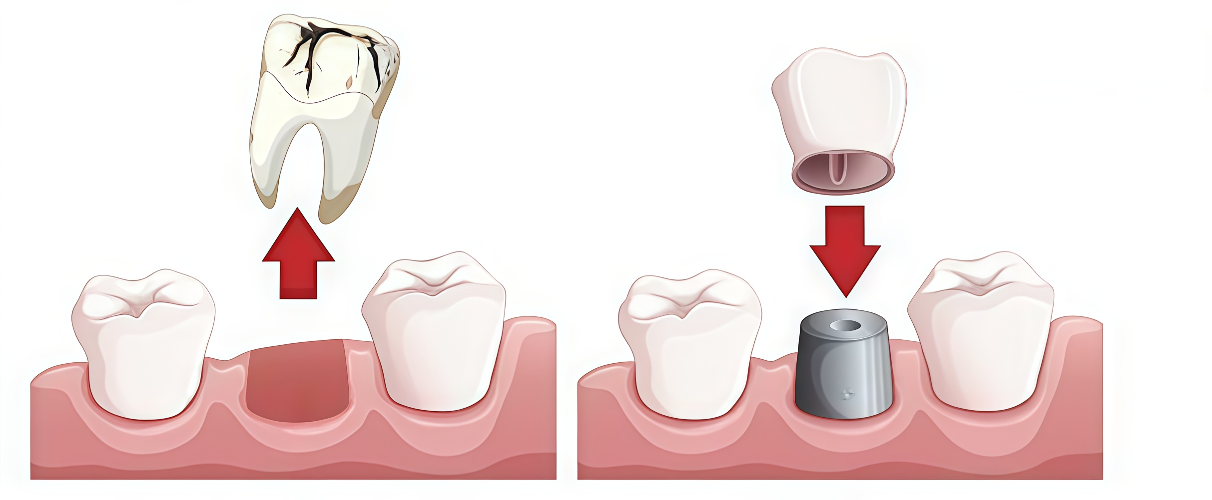 Tooth extraction vs Root canal