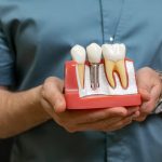 dental implant model