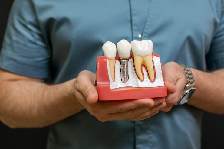 dental implant model
