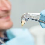 Dental extraction of a broken tooth