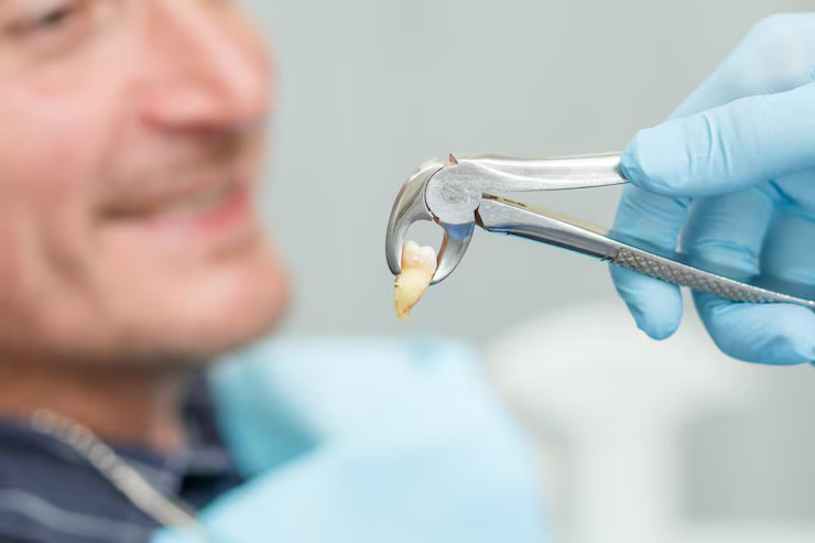 Dental extraction of a broken tooth